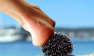 NEZGODA NA PLAŽI: Stali na ježinca? Što nikako ne smijete napraviti!