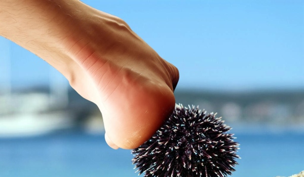 NEZGODA NA PLAŽI: Stali na ježinca? Što nikako ne smijete napraviti!