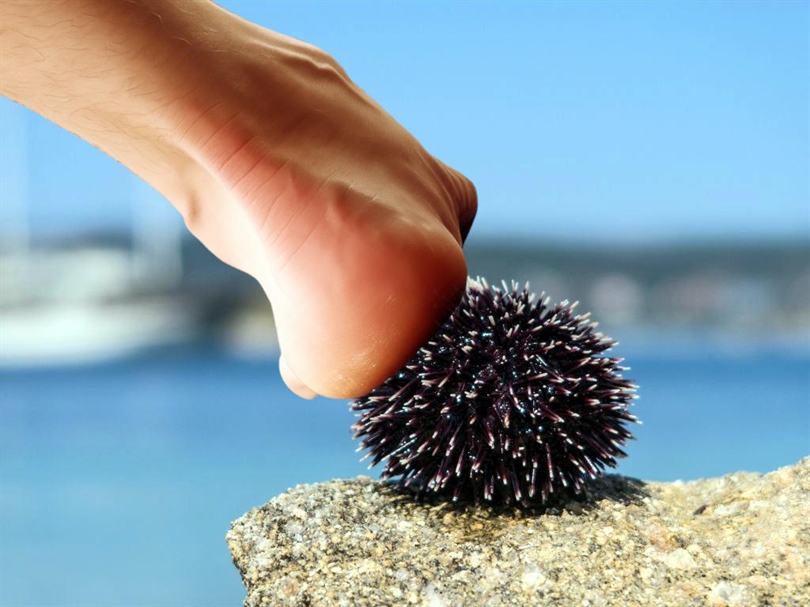 NEZGODA NA PLAŽI: Stali na ježinca? Što nikako ne smijete napraviti!